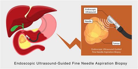 Endoscopic Ultrasound Eus Singapore Endoscopy Procedure