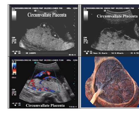 Circumvallate Placenta Placenta Ultrasound Prenatal