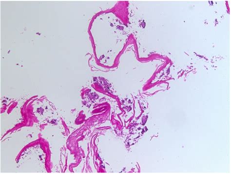 Fungal Esophagitis Presenting With Esophagitis Dissecans Superficialis