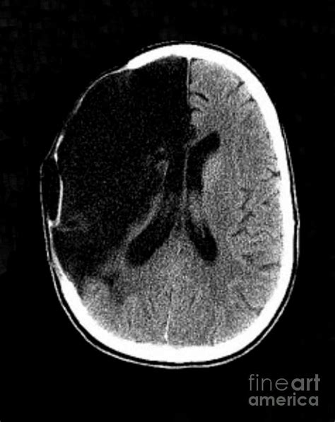 Brain Stroke, Ct Scan Photograph by Science Source - Pixels