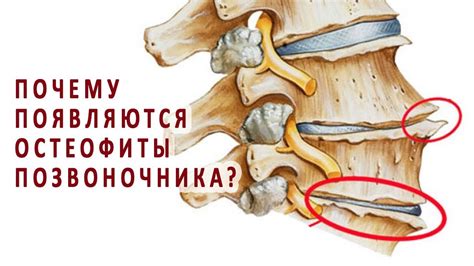 Почему появляются остеофиты позвоночника? - YouTube