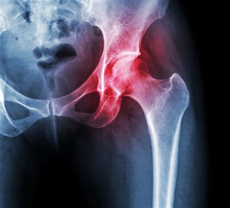 Hip Surgeon Rockhampton | Dr Glenn Gomez