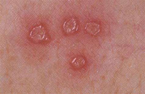 Shingles rash | Shingles Expert