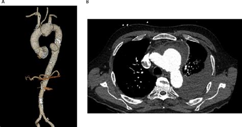 Thoracic Aortic Aneurysm Ct Scan