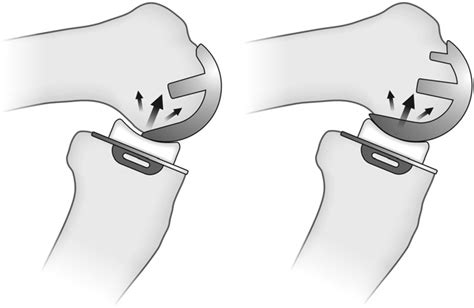 Comparison Of The Phase Iii Oxford Partial Knee Left And The Twin Peg