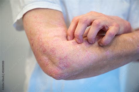 Itchy Psoriasis On Arm And Hand Stock Photo Adobe Stock