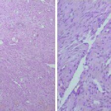 H E Stained Sections Showing Biphasic Pattern Or Zoning Phenomenon