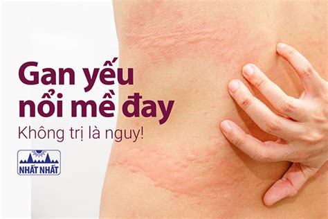 Tìm Hiểu Bệnh Viêm Gan Nổi Mề đay Dấu Hiệu Và Cách điều Trị