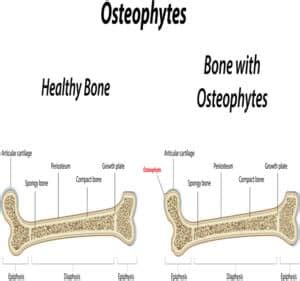 What Do Osteophytes in the Thoracic Spine Mean? | NJ Spine & Orthopedic