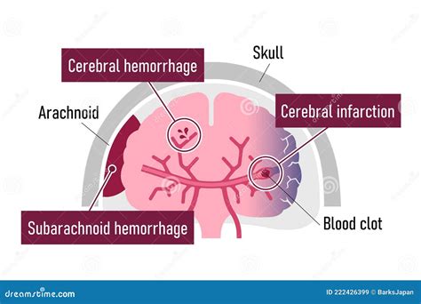 Types Of Human Brain Stroke Vector Illustration Stock Vector