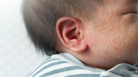 Ear Eczema: Symptoms and Treatments - GoodRx