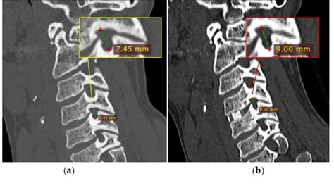 Figure 4 From The Impact Of Single Level Acdf On Neural Foramen And