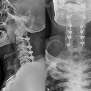 PDF Clinical Application Of The C2 Pars Screw Technique In The