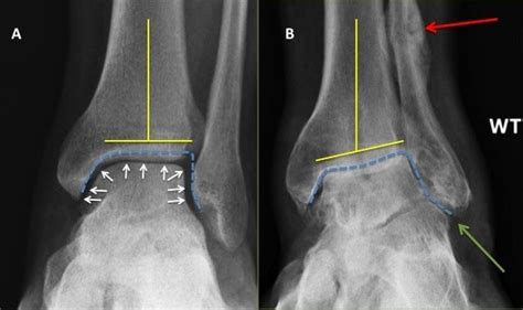 ankle arthritis swollen ankle joint  london foot ankle clinic