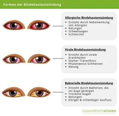 Bindehautentzündung Symptome Ursachen Behandlungen