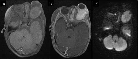 figure   synchronous congenital malignant rhabdoid tumor