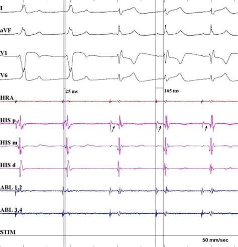 Ablation of a right anteroseptal accessory pathway in a non-coronary... | Download Scientific ...