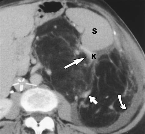 Ct Differentiation Of Large Exophytic Renal Angiomyolipomas And