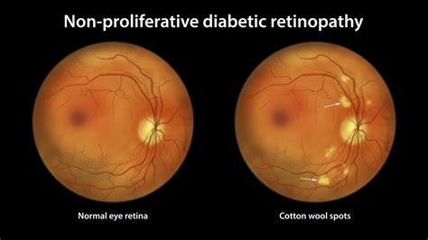 Diabetic Retinopathy Dr Roelof Cronje