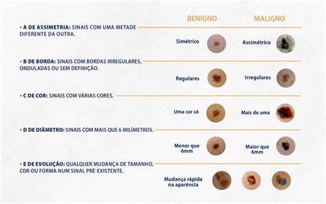 Pintas E Sinais Na Pele Saiba O Que Preciso Ficar De Olho Dr Lu S