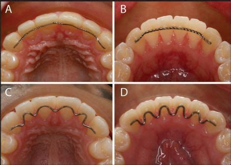 Orthodontic Bonded Retainers Permanent Retainer Orthodontics Retainers