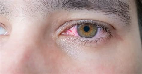 Pink Eye Vs Allergies Understanding The Differences And Symptoms