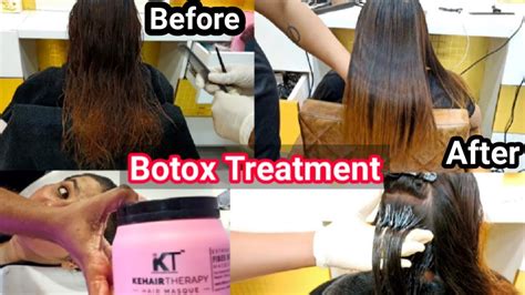 Botox Treatment Step By Step Full Tutorial Kt Fiber Botox Kt