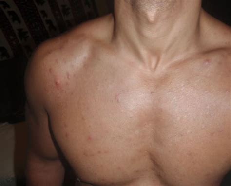 Acne And Testosterone Boosters Are Hormones The Cause Of Spots