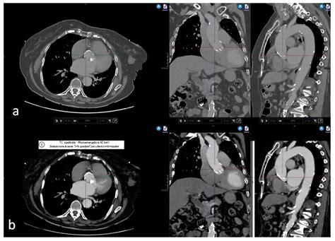 Transcatheter Aortic Valve Implantation (TAVI) Planning with Dual-Layer