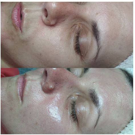 Дермапен Dr Pen Ultima-M5 - купити в Києві | Tufishop.com.ua