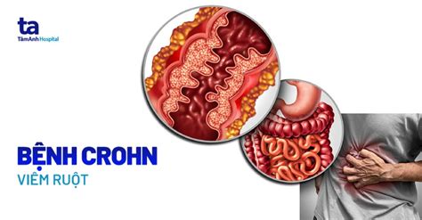 Bệnh crohn viêm ruột mãn tính từng vùng triệu chứng nguyên nhân