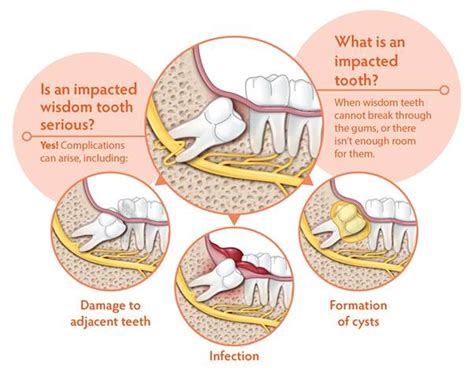 Diagram Of Teeth With Wisdom Teeth - Teeth Poster