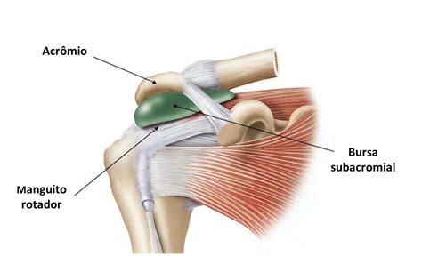 Como Tratar A Bursite No Ombro - Bursite no ombro: causas, sintomas e tratamento - Avantefisio