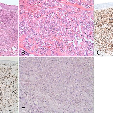 Diffusely Infiltrating Dermal Tumor With High Cell Density Intense