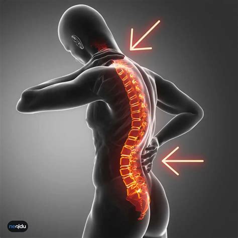 Skolyoz Nedir Omurga E Rili I Belirtileri Ve Tedavisi