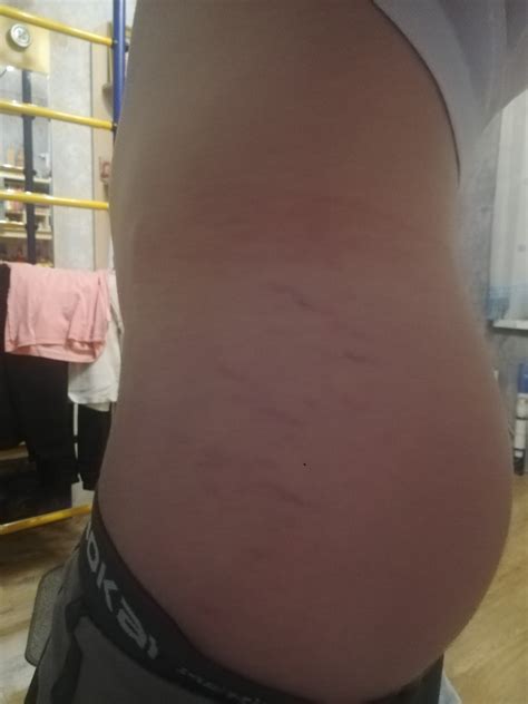 Растяжки на коже у ребёнка? - Вопрос педиатру - 03 Онлайн