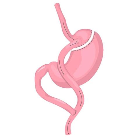 gastric bypass  turkey remedy istanbul