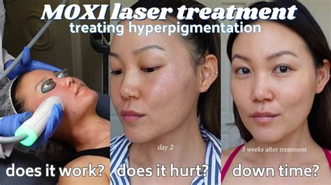 Is It Worth It Moxi Laser Treatment For Hyperpigmentation Skin