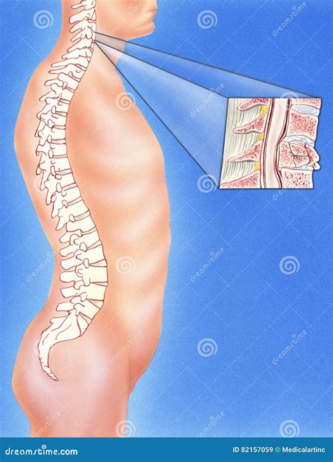 Spine Broken Neck Showing Cervical Vertebra Fracture Stock