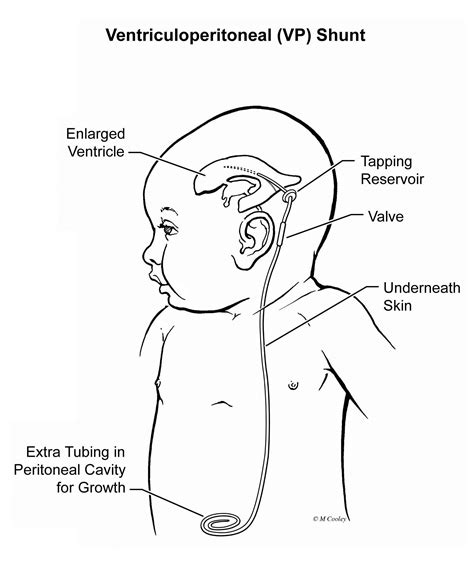 hydrocephalus diagram vrogueco