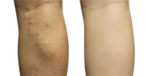 What are the Benefits of VenaSeal?