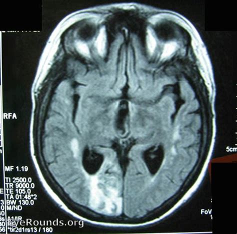 Atlas Entry Left Homonymous Hemianopsia Occipital Stroke