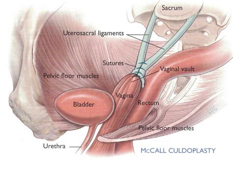 Laparoscopic Vault Suspension Women S Health Centre Gold Coast