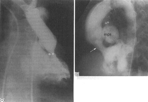 Aetiology of a long systolic or pansystolic murmur in patients after... | Download Scientific ...