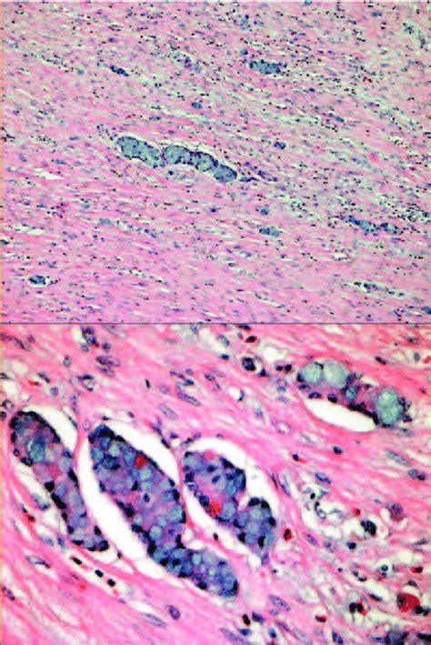 upper panel goblet cell carcinoid characterised  nests  goblet