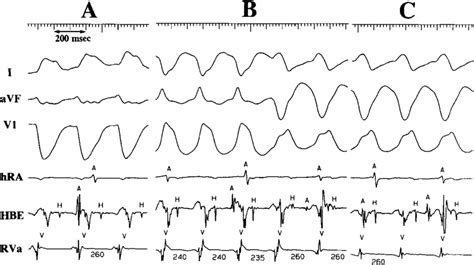 Ventricular Tachycardias Of Patient Simultaneous Mm S Tracings