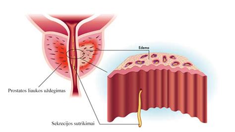 Lėtinis prostatitas diagnostika gydymas vaistai Urologas Kaune