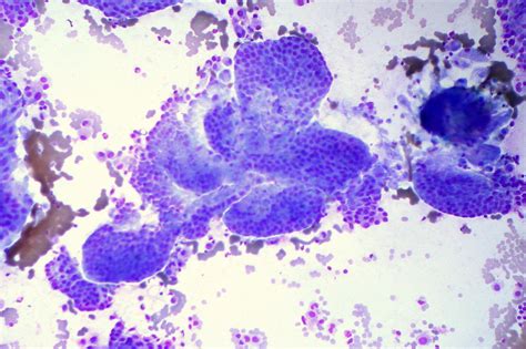 Papillary Thyroid Carcinoma Fna Giemsa Stain Complex Pap Flickr