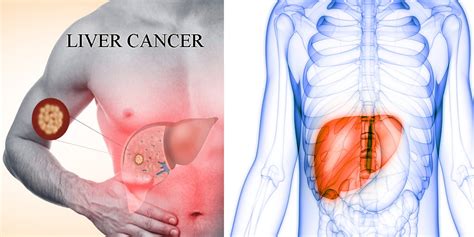 Liver Cancer Symptoms And Treatments Good Health Facts