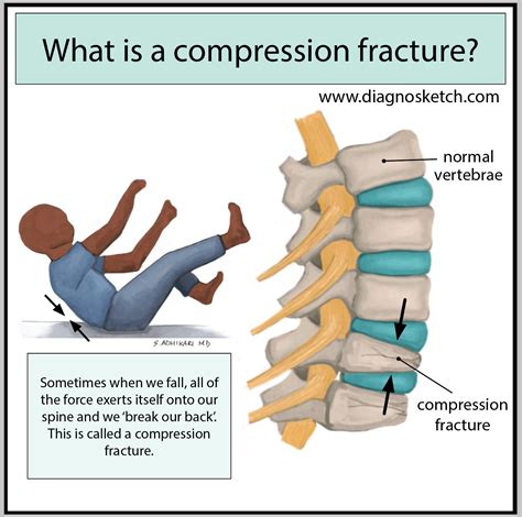 What is a compression fracture? - by Sapana Adhikari, MD